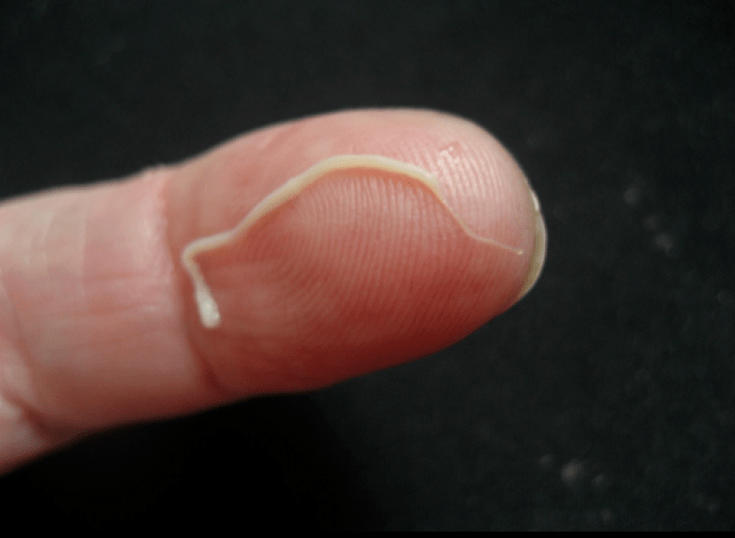 Στρογγυλό παράσιτο από το ανθρώπινο σώμα